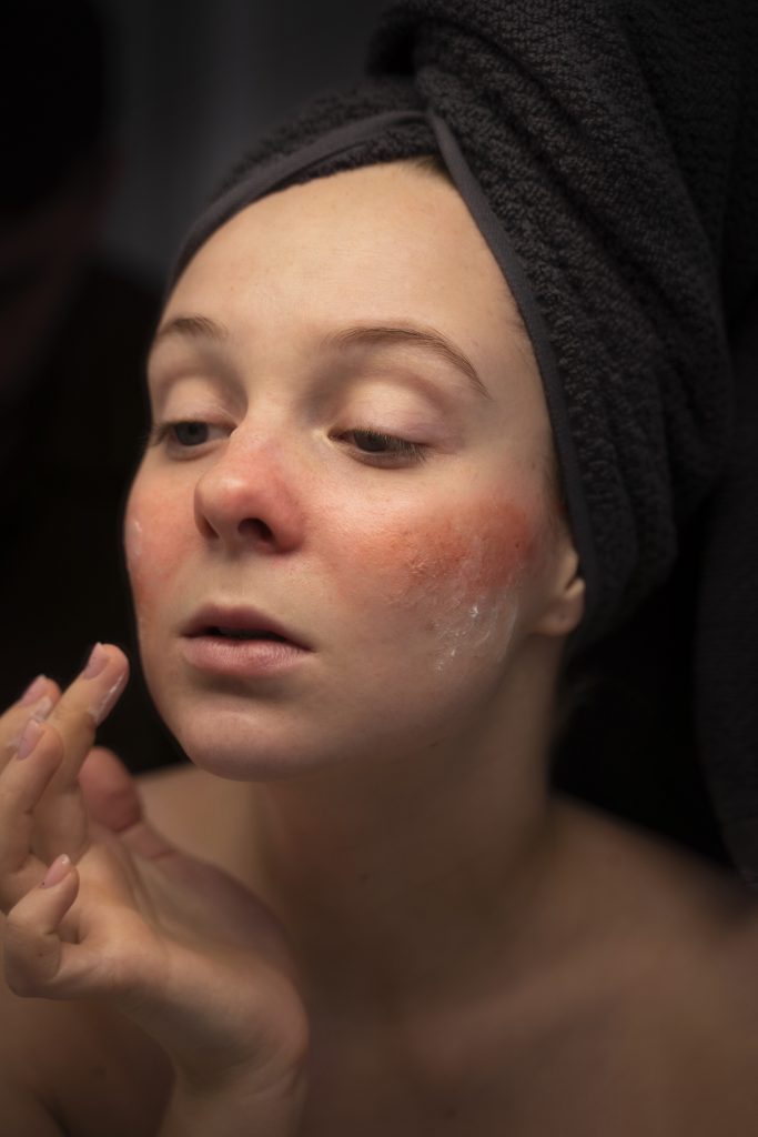 Mujer con rosácea en la cara aplicando un cosmético. Desencadenantes de la rosácea